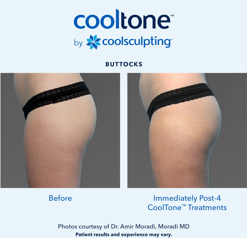 CoolTone Before & After Results