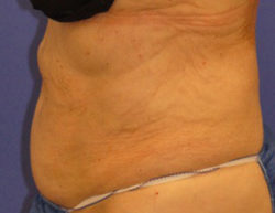 CoolSculpting