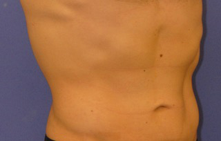 CoolSculpting