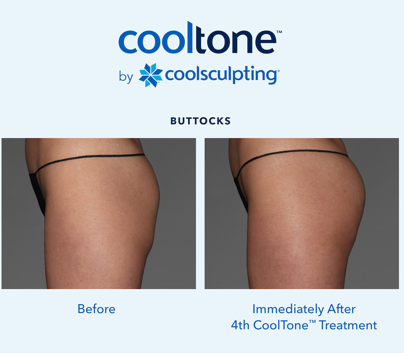 CoolTone Before & After Results