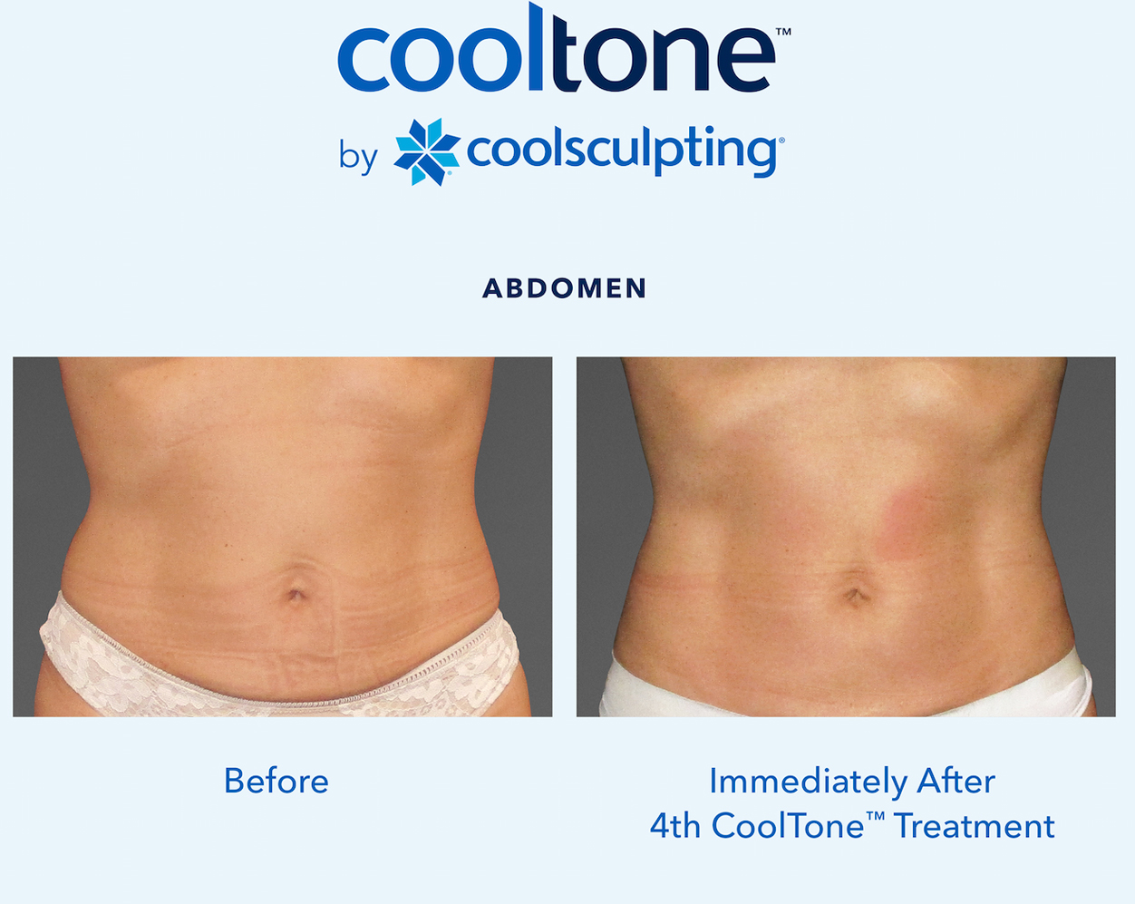 CoolTone Before & After Results