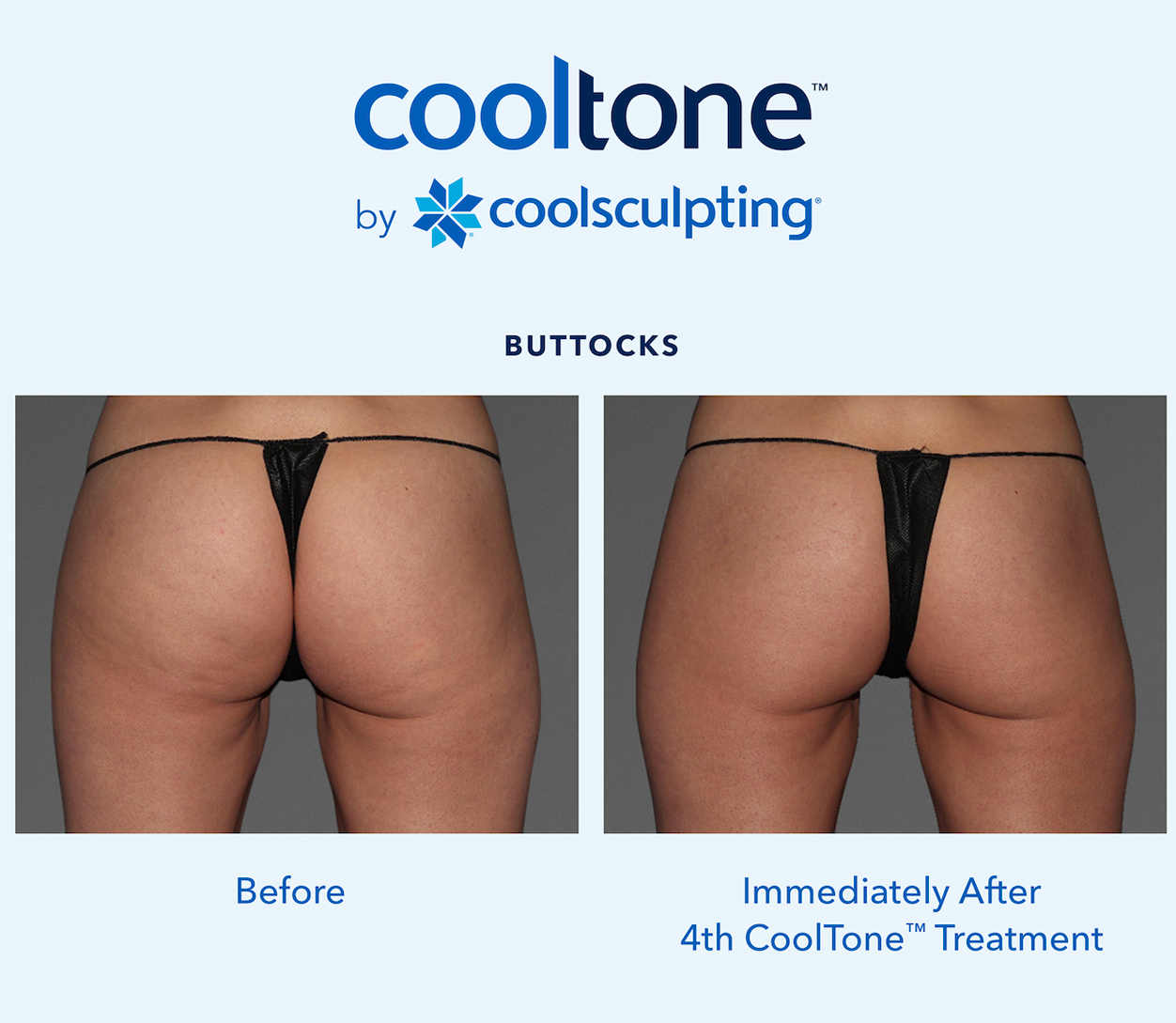 CoolSculpting Before & After Results