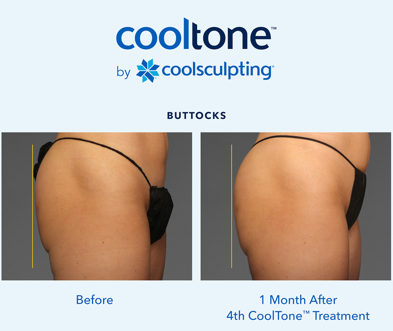 CoolTone Before & After Results