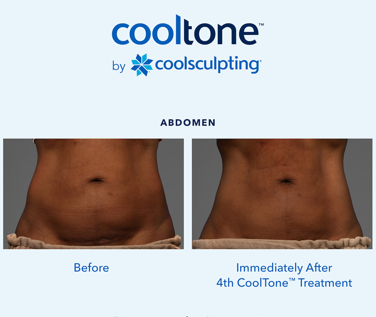 CoolTone Before & After Results