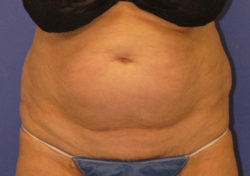 CoolSculpting