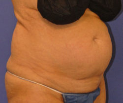 CoolSculpting