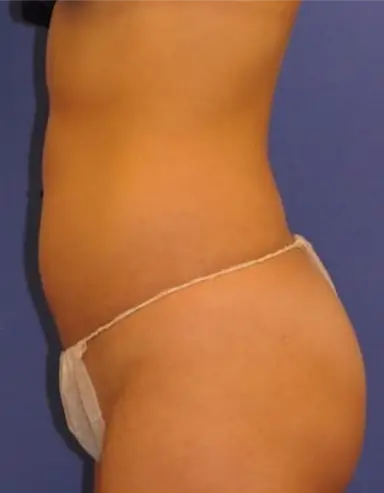 side view before coolsculpting