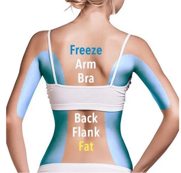 Coolsculpting female freeze fat
